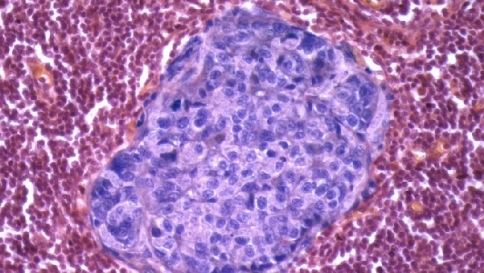 Per sconfiggere il cancro al seno arriva una "sveglia" per il sistema immunitario