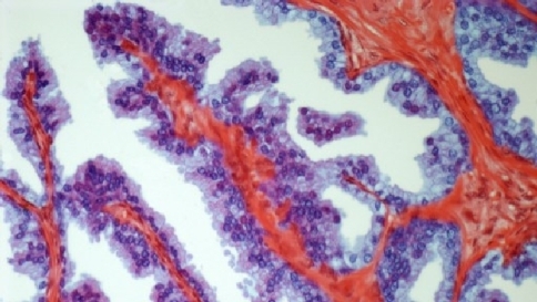 Cancro alla prostata, un uomo su due non sa riconoscere i sintomi