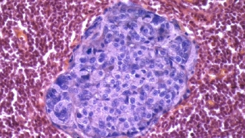 Cancro al polmone, l'immunoterapia "cura" il 51 per cento dei malati