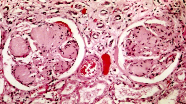 Diabete, trapiantate cellule del pancreas su un 41enne a Milano: "Addio alle iniezioni di insulina"