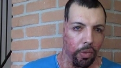 Fece sfregiare con l'acido il suo ex, oggi le tolgono il bambino di tre anni