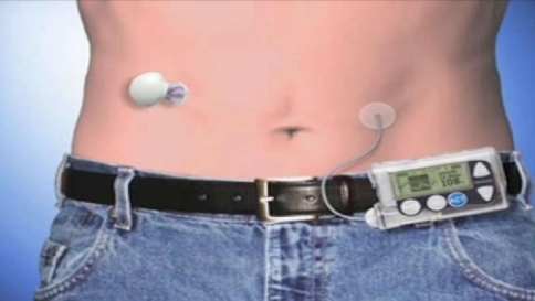Diabete, arriva il diffusore di insulina "intelligente" che previene l'ipoglicemia
