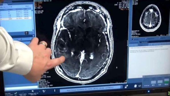 Alzheimer, osservata una regressione delle placche nel cervello dei topi