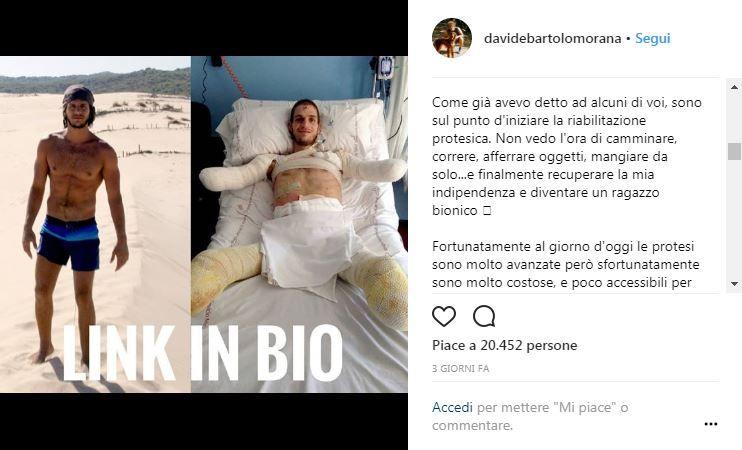 Perde gambe e braccia per la meningite: lancia una raccolta fondi per le protesi