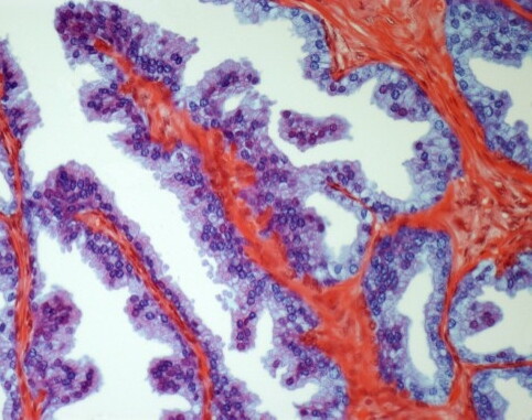 cancro alla prostata, prostata, cancro, tumore
