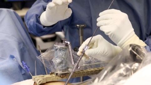 mazor robot neurochirurgia torino