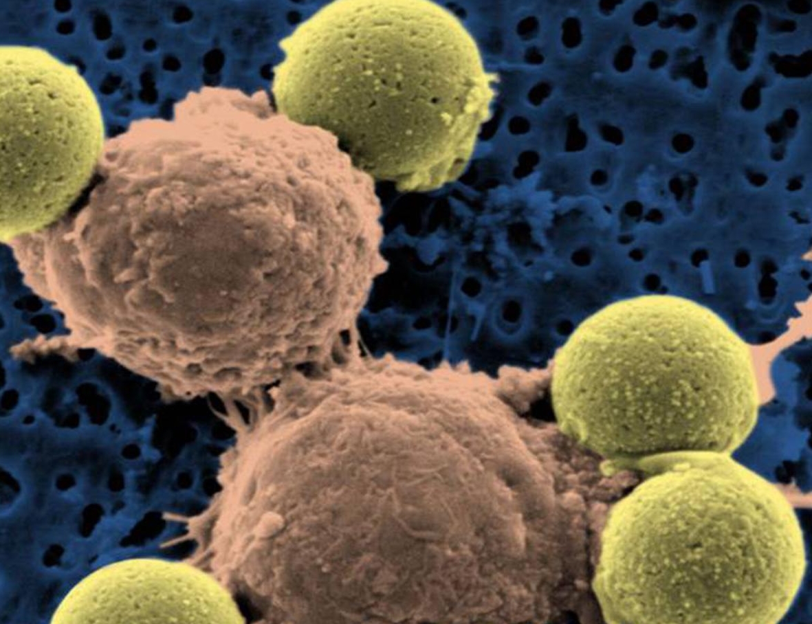 tumore,cancro,leucemia