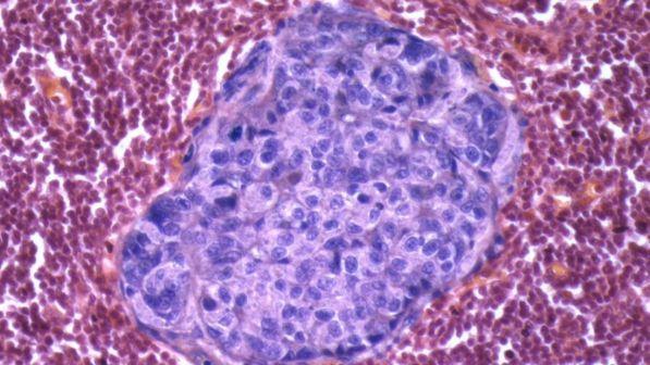 Lotta al cancro, una ricerca italiana scopre il segreto della "droga" dei tumori