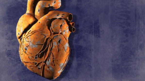Infarto, quasi uno su due è "silenzioso": arriva senza sintomi e sfugge alle cure
