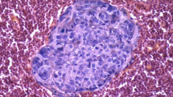 Tumori, studio italiano: scoperta una nuova proteina "bersaglio" contro il cancro al colon