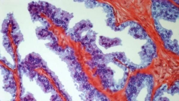 analisi del sangue della prostata
