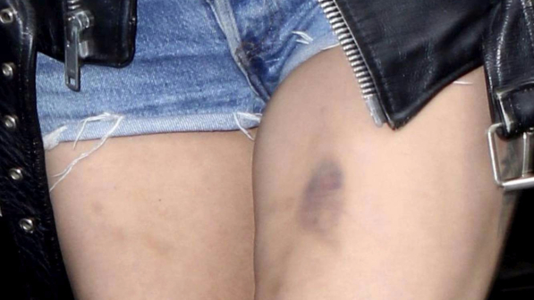 Chi è la star con le gambe piene di lividi?