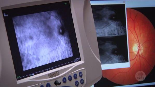 Milano, a non vedente impiantato per la prima volta una protesi retina