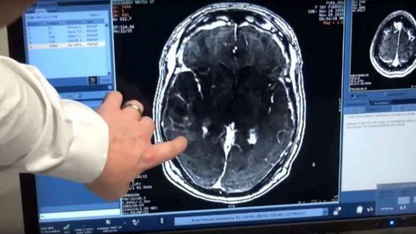 Tumori, scoperto il meccanismo che causa metastasi al cervello