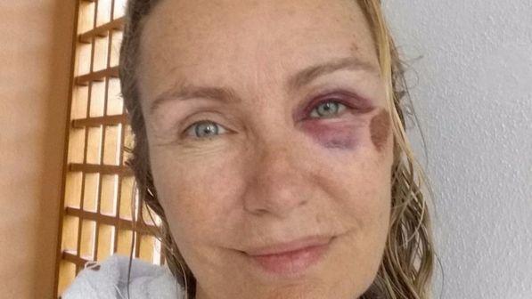 Licia Colò, che botta! "Felice di essere ancora con voi"
