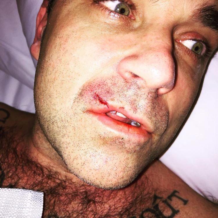 Robbie Williams ferito dopo uno scontro... con un computer