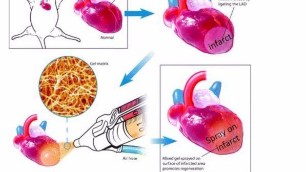 Dagli Stati Uniti arriva uno spray che "ripara" il cuore dopo l'infarto
