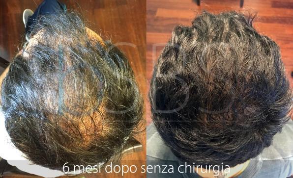 Caduta dei capelli in primavera: è tempo della terapia di Rigenerazione Cellulare